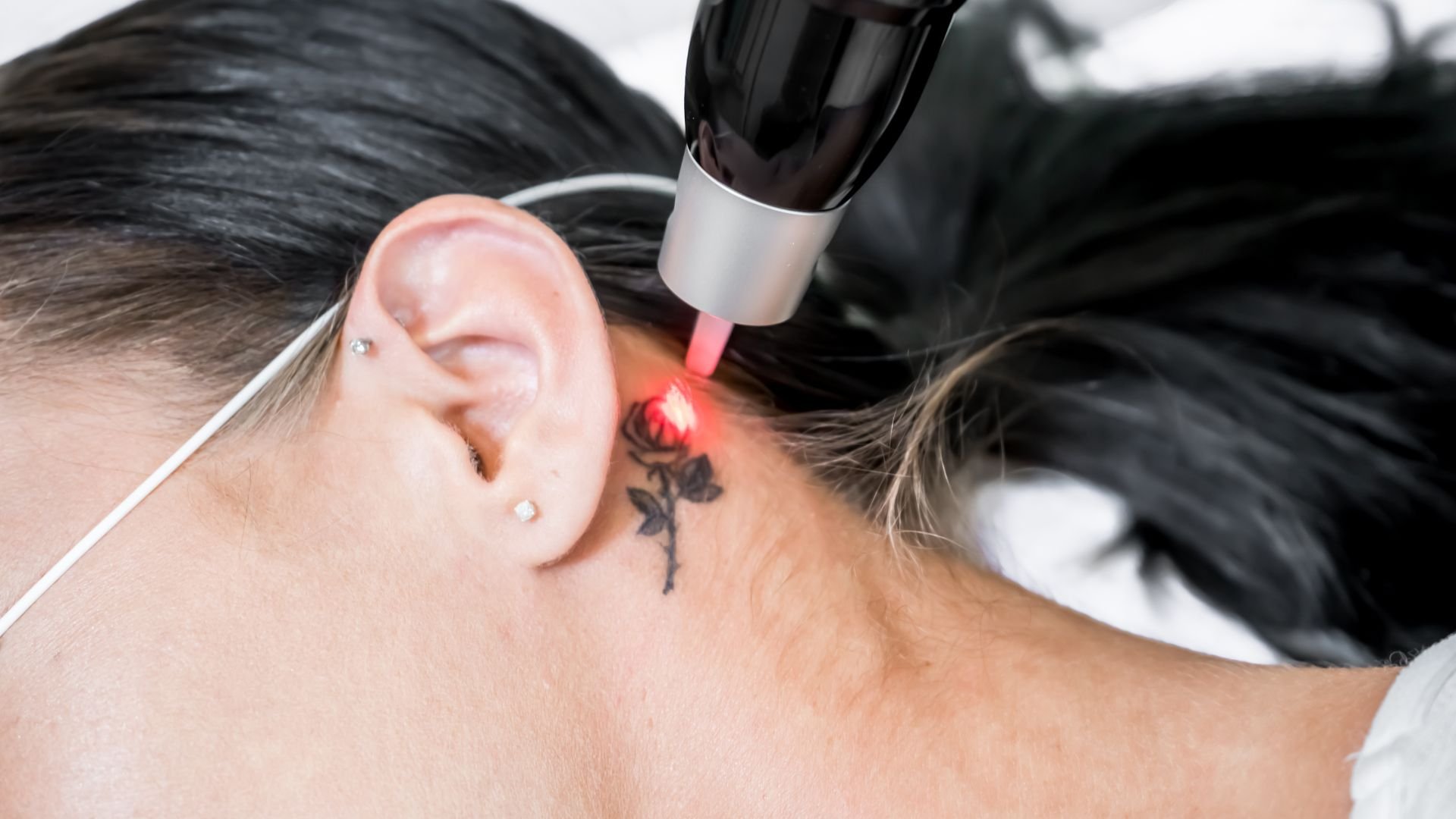 Laser tattoo removal procedure targeting a small rose tattoo near ear